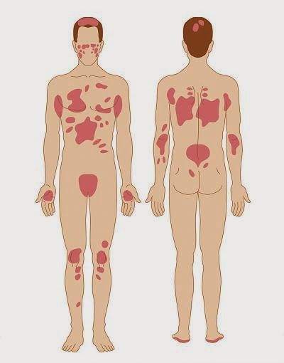 Trattamento dacqua di psoriasi del Mar Morto